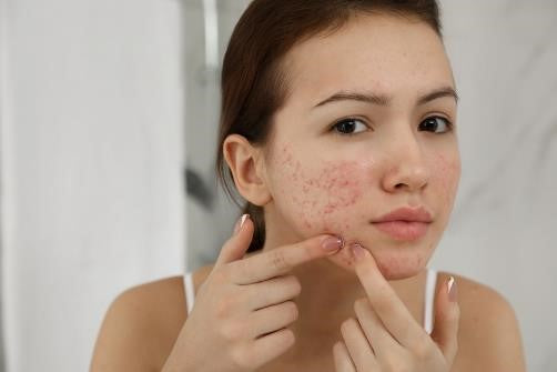 a woman showing acne breakout on her face